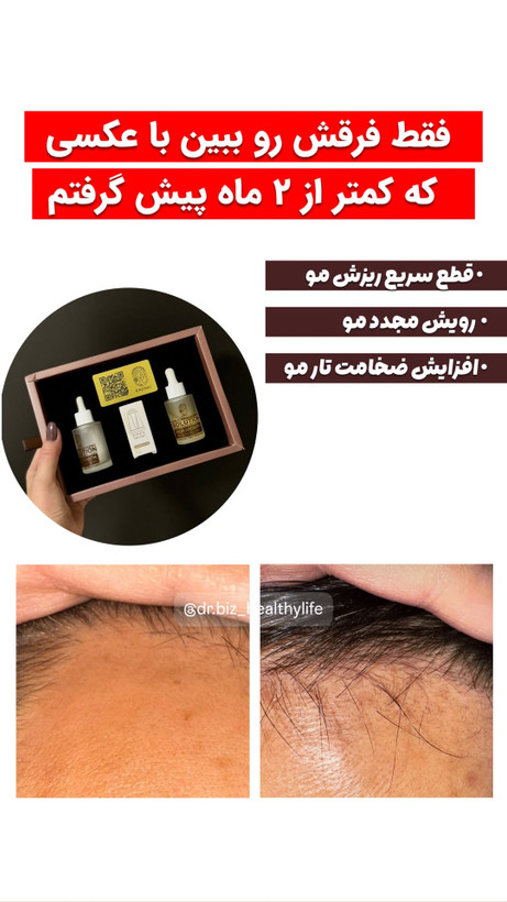 تونیک ضد ریزش و محرک رشد مجدد مو به همراه اپلیکاتور - EXONIC تونیک یک عددی